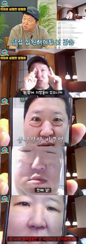 정형돈, 눈밑지방재배치 수술 직후 만족 후기 공개